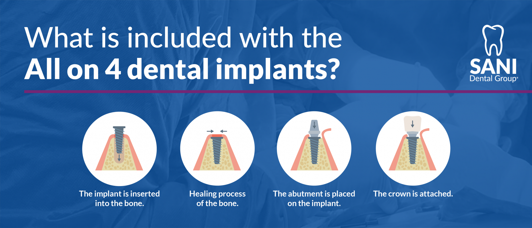 A Quick Guide on the All On 4 Dental Implants Procedure